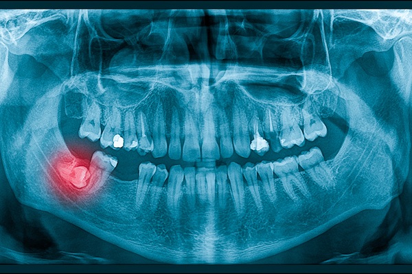 Wisdom Teeth Removal: What To Know